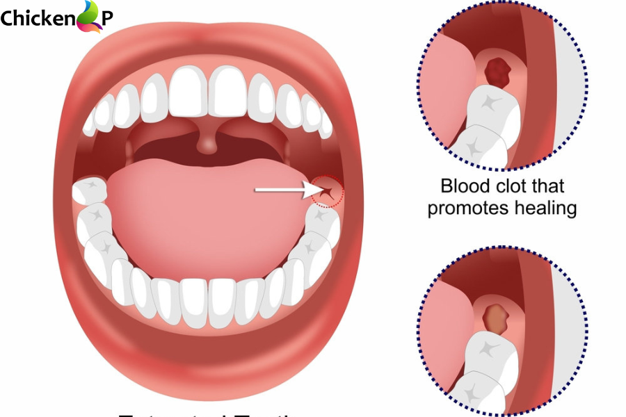 day 3 healing normal socket after tooth extraction