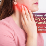 pictures of dry socket vs normal healing