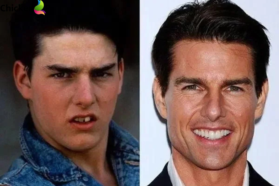 celebrity before and after dentures