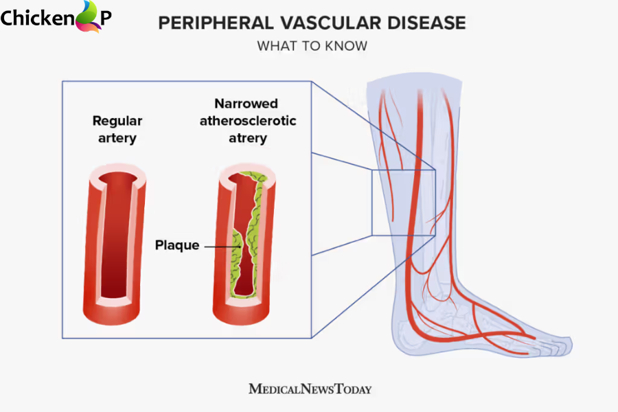 how to diagnose pavatalgia disease